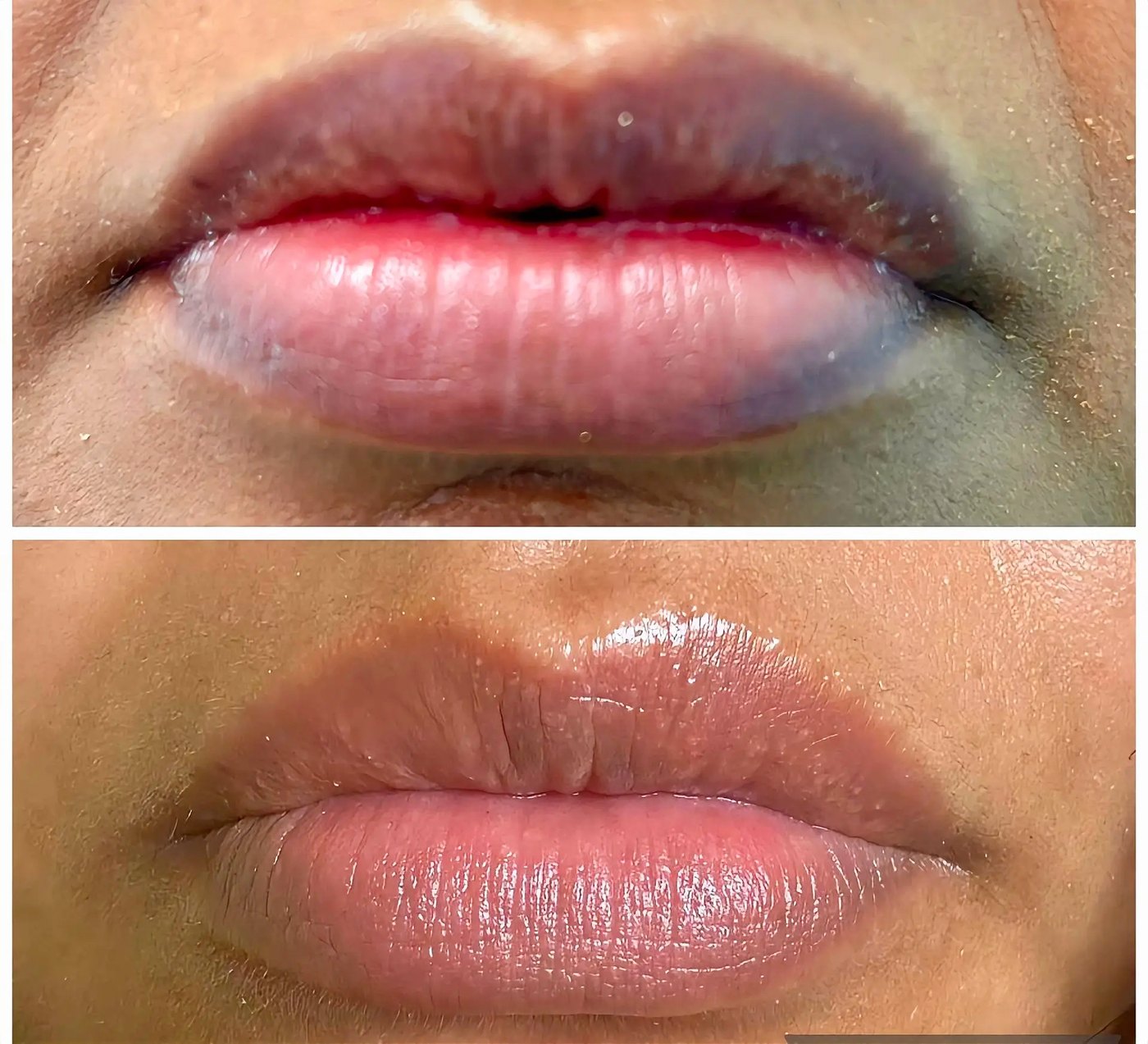 Dark Lip Neutralisation & Lip Blush result